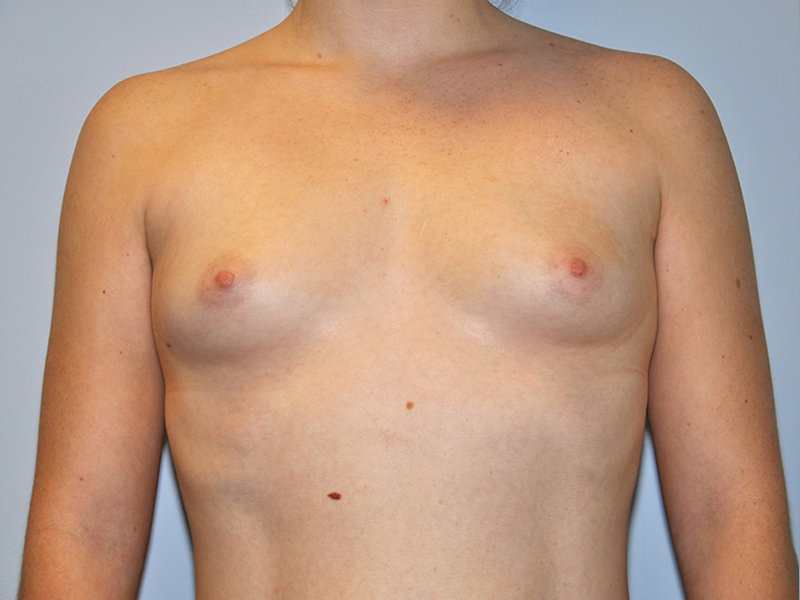 Breast Augmentation Before and After | Steven Ringler MD - Center for Aesthetics And Plastic Surgery