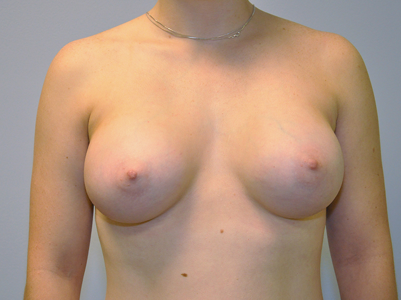 Breast Augmentation Before and After | Steven Ringler MD - Center for Aesthetics And Plastic Surgery