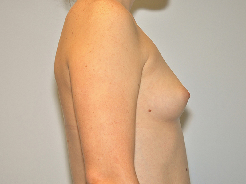 Breast Augmentation Before and After | Steven Ringler MD - Center for Aesthetics And Plastic Surgery