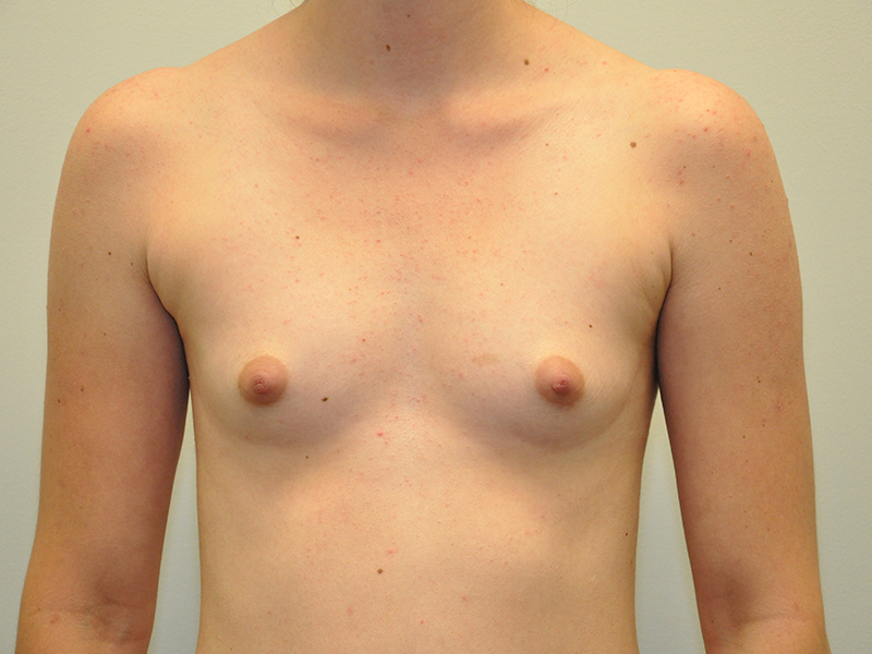 Breast Augmentation Before and After | Steven Ringler MD - Center for Aesthetics And Plastic Surgery