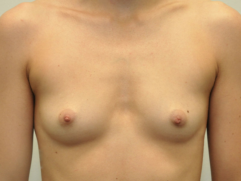 Breast Augmentation Before and After | Steven Ringler MD - Center for Aesthetics And Plastic Surgery