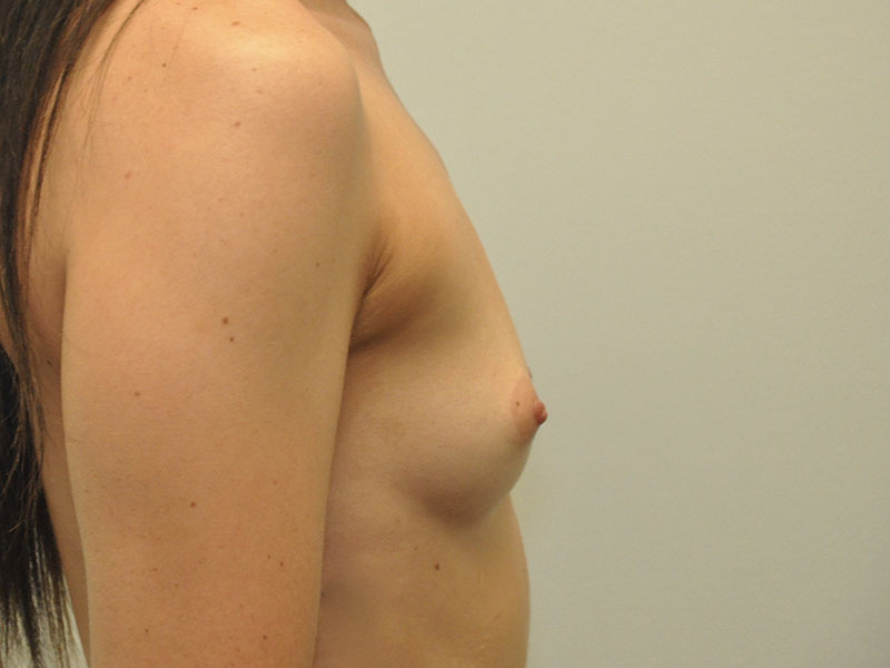 Breast Augmentation Before and After | Steven Ringler MD - Center for Aesthetics And Plastic Surgery