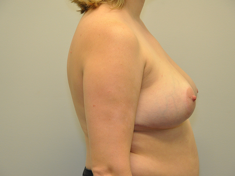 Breast Lift Before and After | Steven Ringler MD - Center for Aesthetics And Plastic Surgery