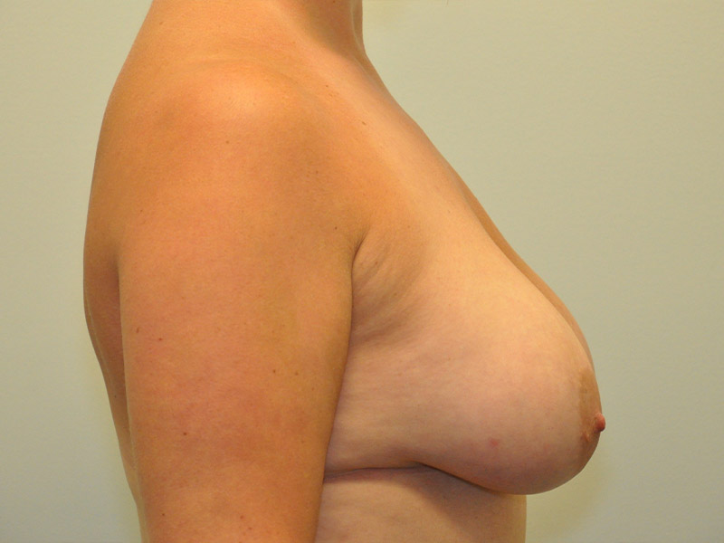 Breast Lift Before and After | Steven Ringler MD - Center for Aesthetics And Plastic Surgery
