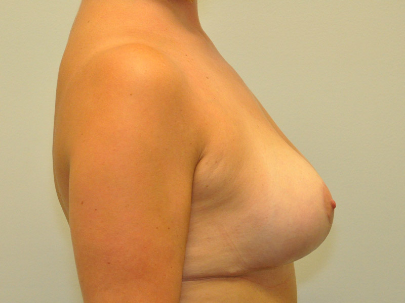 Breast Lift Before and After | Steven Ringler MD - Center for Aesthetics And Plastic Surgery