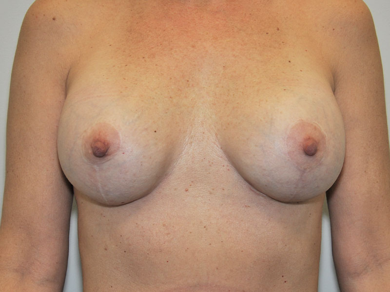 Grand Rapids Breast Lift