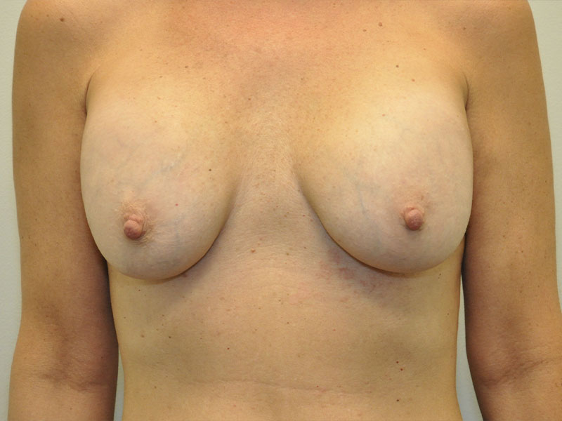 Breast Revision Before and After | Steven Ringler MD - Center for Aesthetics And Plastic Surgery
