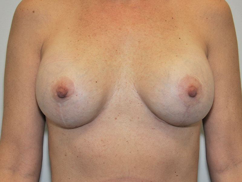 Breast Revision Before and After | Steven Ringler MD - Center for Aesthetics And Plastic Surgery