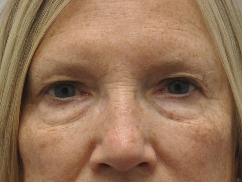 Eyelid surgery in Michigan before 1