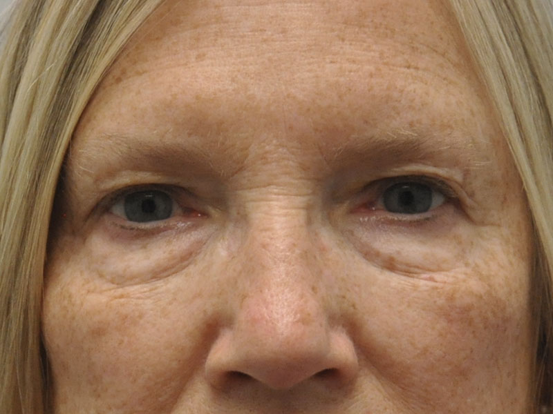 Blepharoplasty Before and After | Steven Ringler MD - Center for Aesthetics And Plastic Surgery