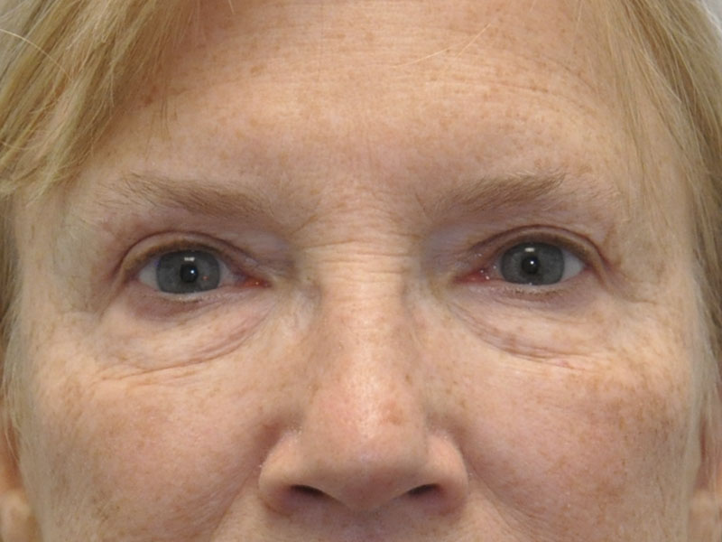 Eyelid surgery in Michigan after 1