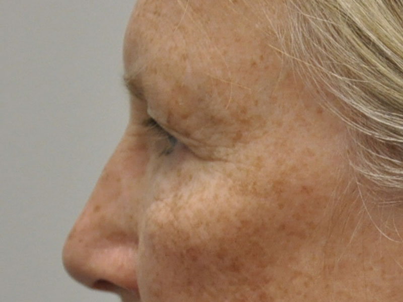 Blepharoplasty Before and After | Steven Ringler MD - Center for Aesthetics And Plastic Surgery