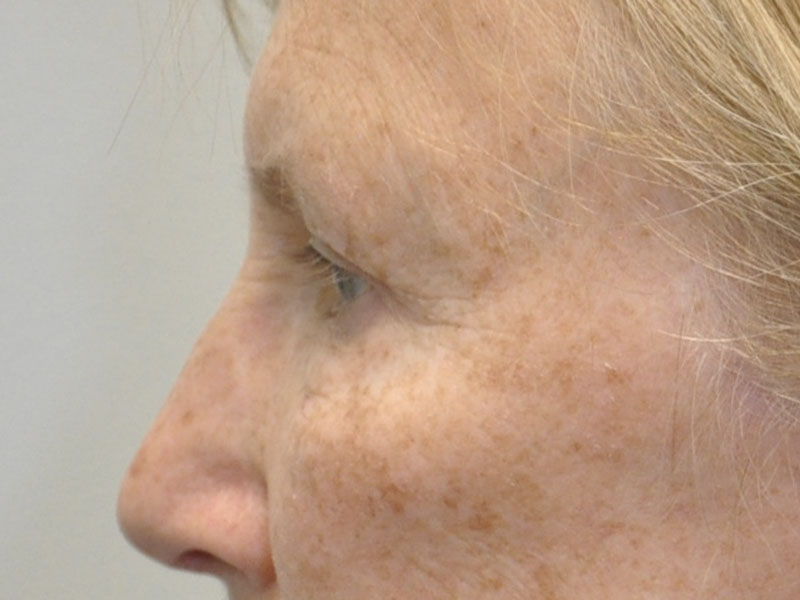Blepharoplasty Before and After | Steven Ringler MD - Center for Aesthetics And Plastic Surgery