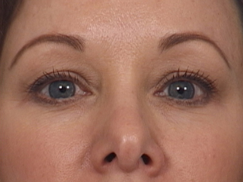 Eyelid surgery in Michigan before 2