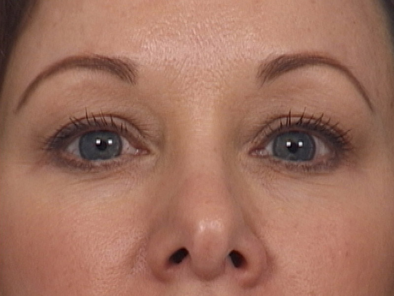 Blepharoplasty Before and After | Steven Ringler MD - Center for Aesthetics And Plastic Surgery