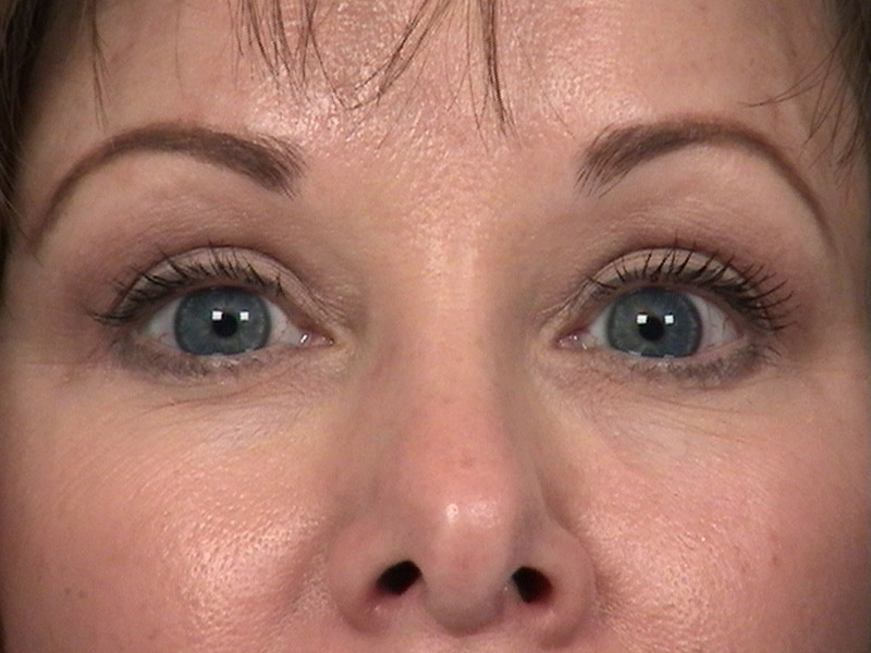 Eyelid surgery in Michigan after 2