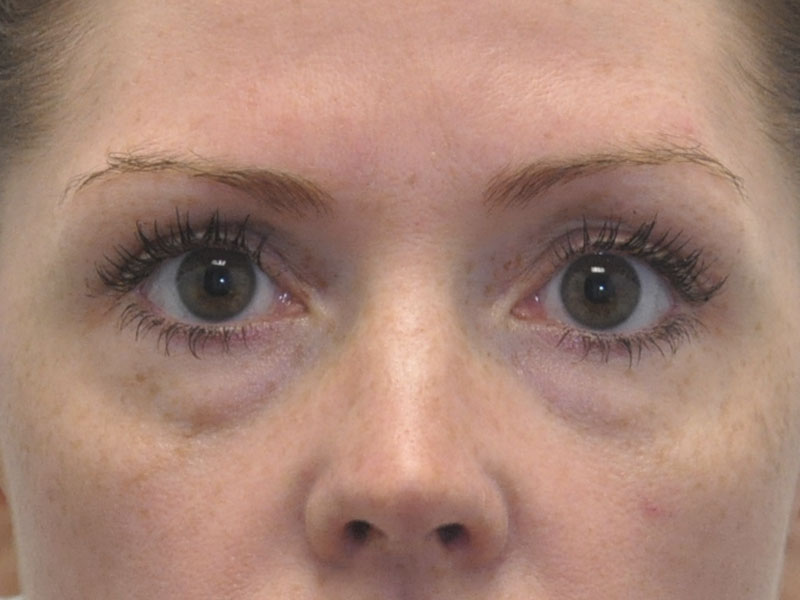 Blepharoplasty Before and After | Steven Ringler MD - Center for Aesthetics And Plastic Surgery