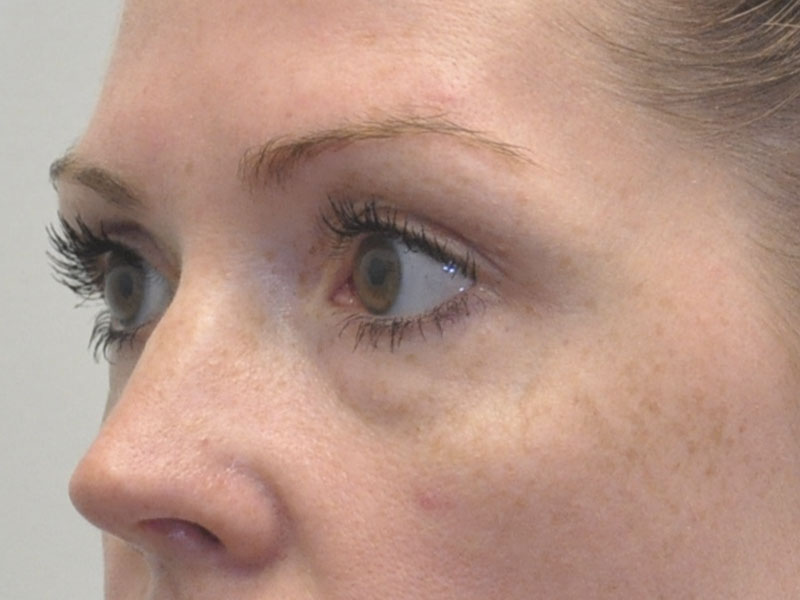 Blepharoplasty Before and After | Steven Ringler MD - Center for Aesthetics And Plastic Surgery