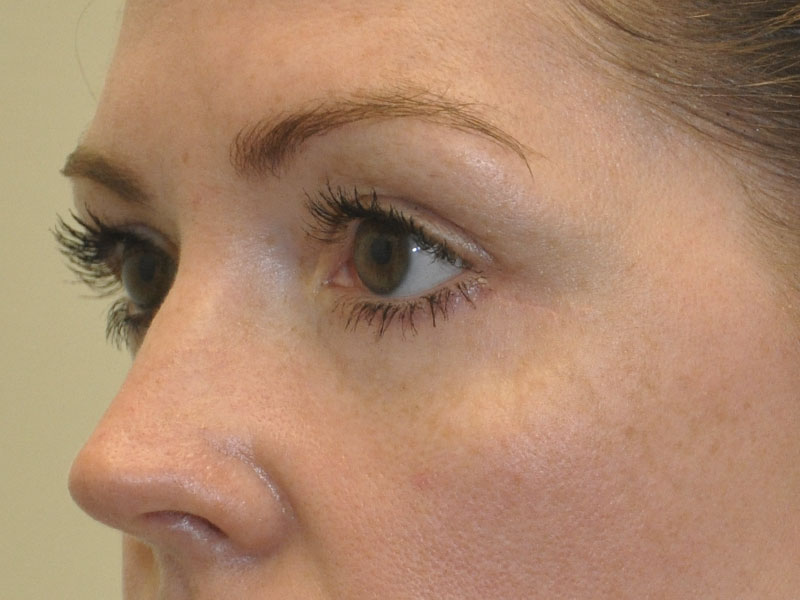 Blepharoplasty Before and After | Steven Ringler MD - Center for Aesthetics And Plastic Surgery