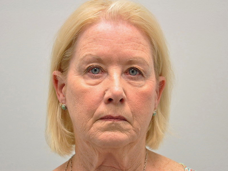 Facelift Before and After | Steven Ringler MD - Center for Aesthetics And Plastic Surgery