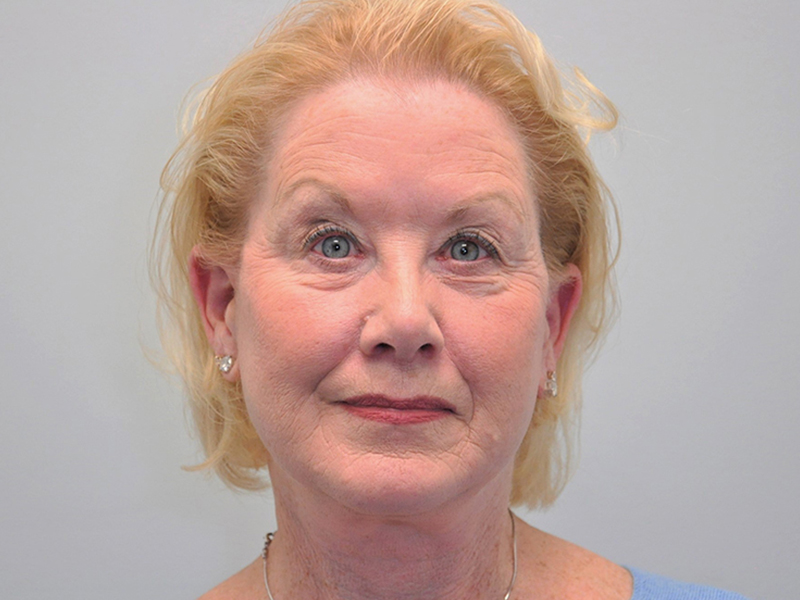 Facelift Before and After | Steven Ringler MD - Center for Aesthetics And Plastic Surgery