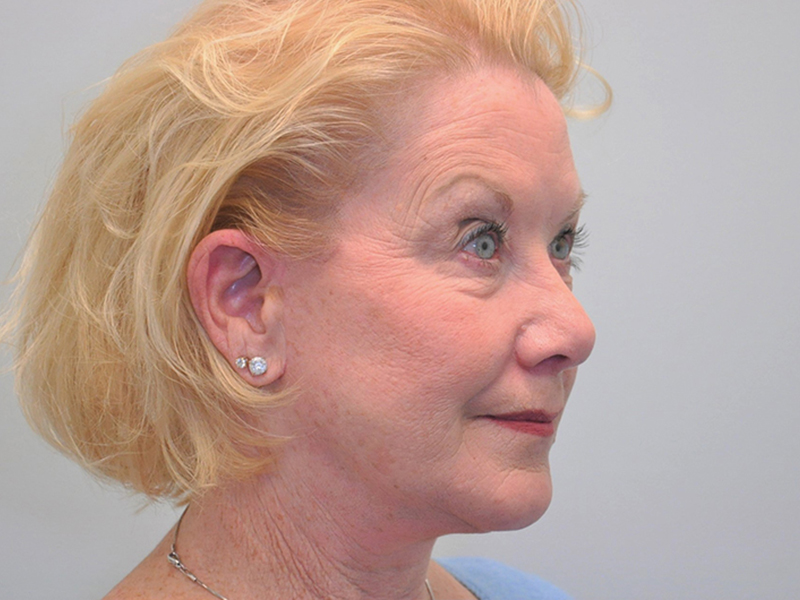 Facelift Before and After | Steven Ringler MD - Center for Aesthetics And Plastic Surgery