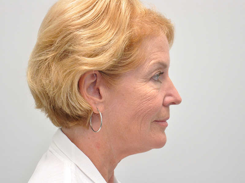 Facelift Before and After | Steven Ringler MD - Center for Aesthetics And Plastic Surgery