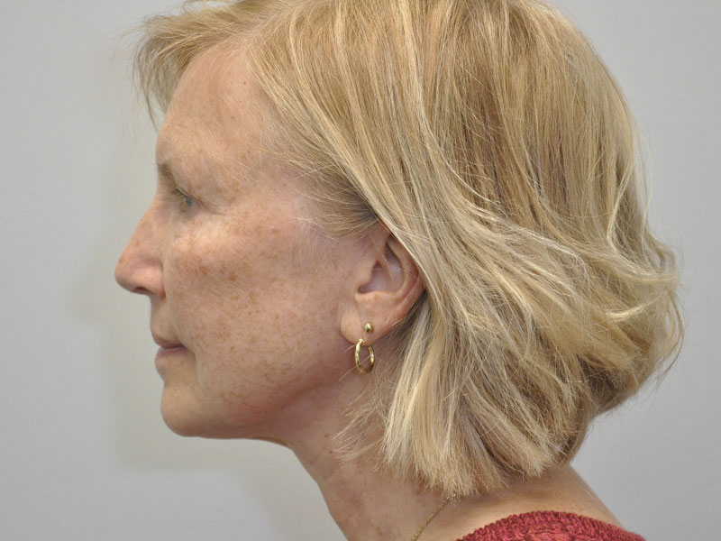 Facial Fat Grafting Before and After | Steven Ringler MD - Center for Aesthetics And Plastic Surgery