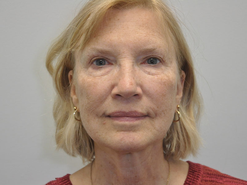 Neck Lift Before and After | Steven Ringler MD - Center for Aesthetics And Plastic Surgery