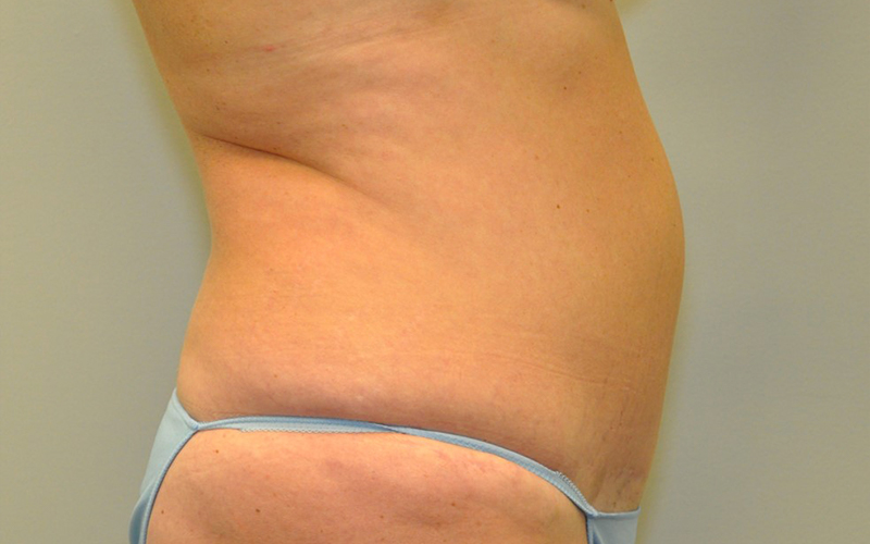 Emsculpt Before and After | Steven Ringler MD - Center for Aesthetics And Plastic Surgery