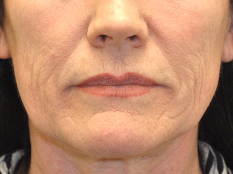 Halo Before and After | Steven Ringler MD - Center for Aesthetics And Plastic Surgery