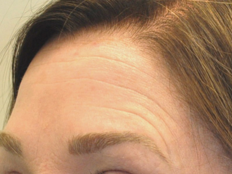 Halo Before and After | Steven Ringler MD - Center for Aesthetics And Plastic Surgery