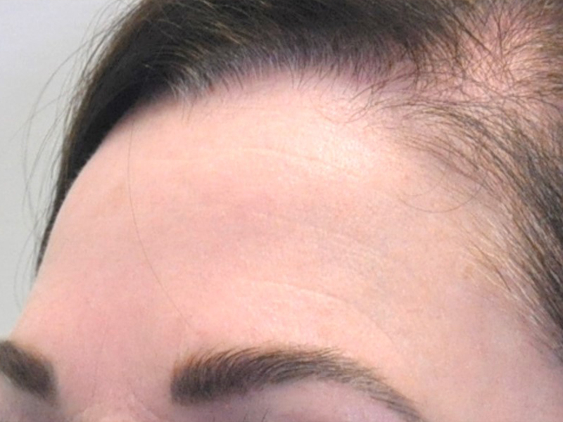 Halo Before and After | Steven Ringler MD - Center for Aesthetics And Plastic Surgery