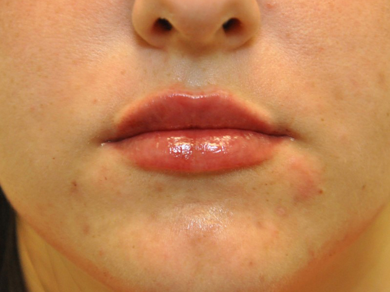 Injectables Before and After | Steven Ringler MD - Center for Aesthetics And Plastic Surgery