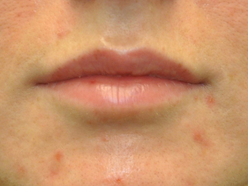 Injectables Before and After | Steven Ringler MD - Center for Aesthetics And Plastic Surgery