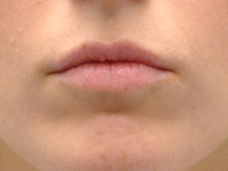 Injectables Before and After | Steven Ringler MD - Center for Aesthetics And Plastic Surgery