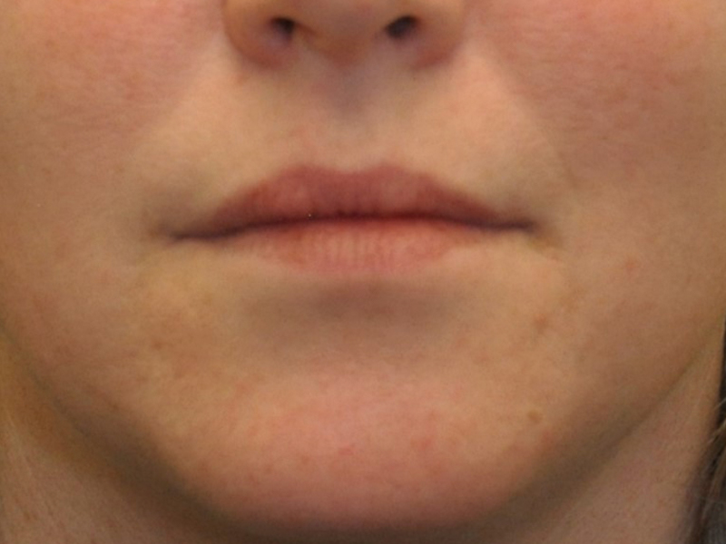 Injectables Before and After | Steven Ringler MD - Center for Aesthetics And Plastic Surgery
