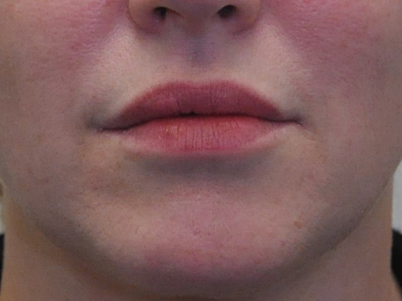 Injectables Before and After | Steven Ringler MD - Center for Aesthetics And Plastic Surgery