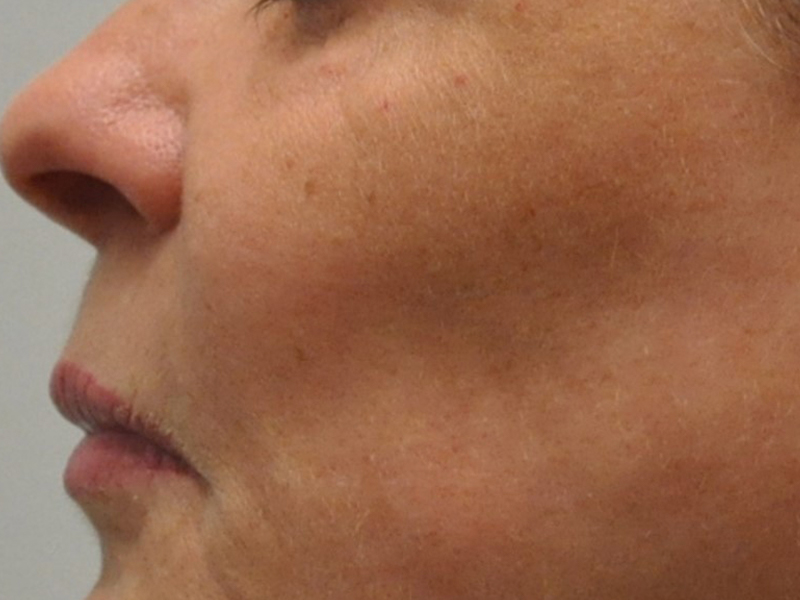 Injectables Before and After | Steven Ringler MD - Center for Aesthetics And Plastic Surgery