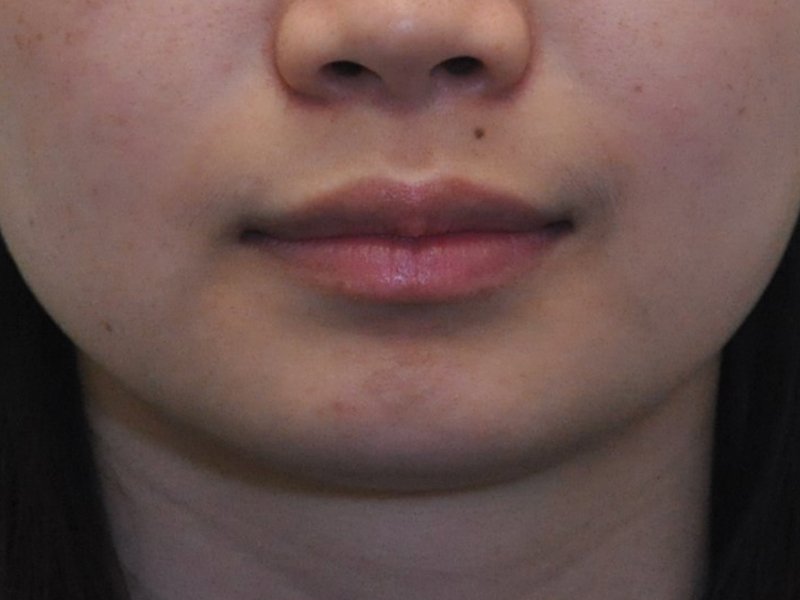 Injectables Before and After | Steven Ringler MD - Center for Aesthetics And Plastic Surgery