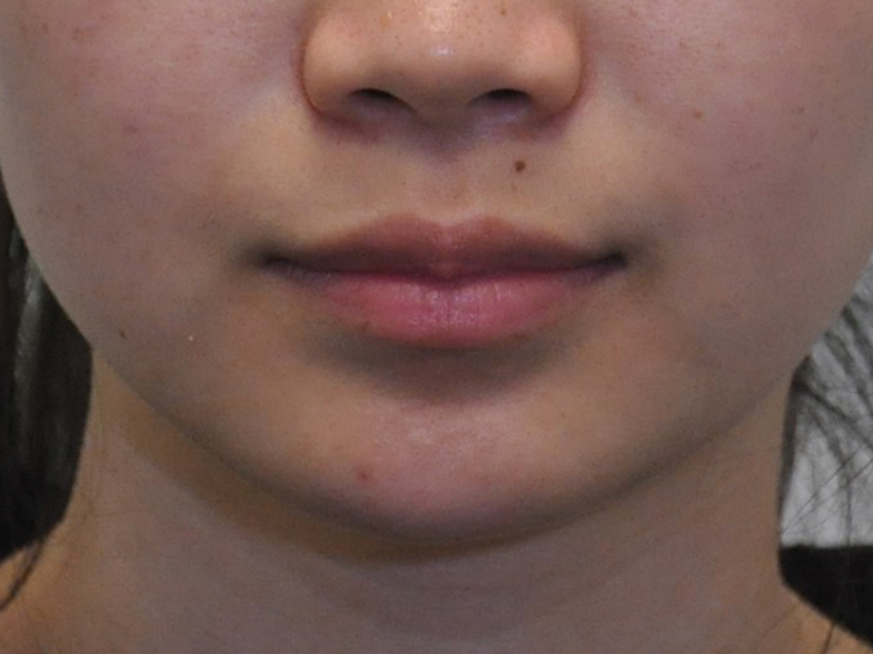 Injectables Before and After | Steven Ringler MD - Center for Aesthetics And Plastic Surgery