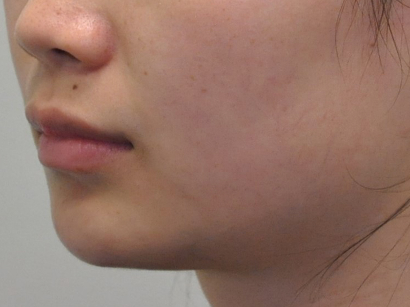 Injectables Before and After | Steven Ringler MD - Center for Aesthetics And Plastic Surgery