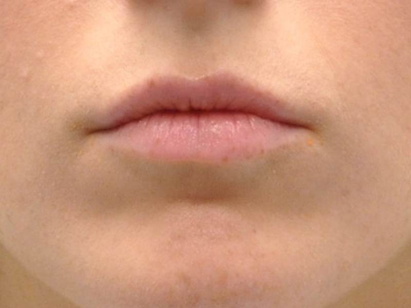 Injectables Before and After | Steven Ringler MD - Center for Aesthetics And Plastic Surgery