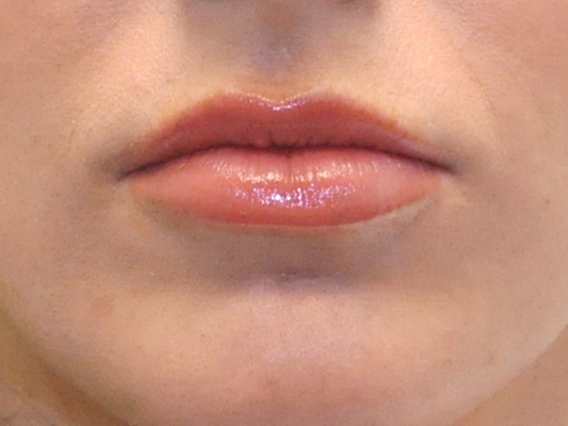 Injectables Before and After | Steven Ringler MD - Center for Aesthetics And Plastic Surgery