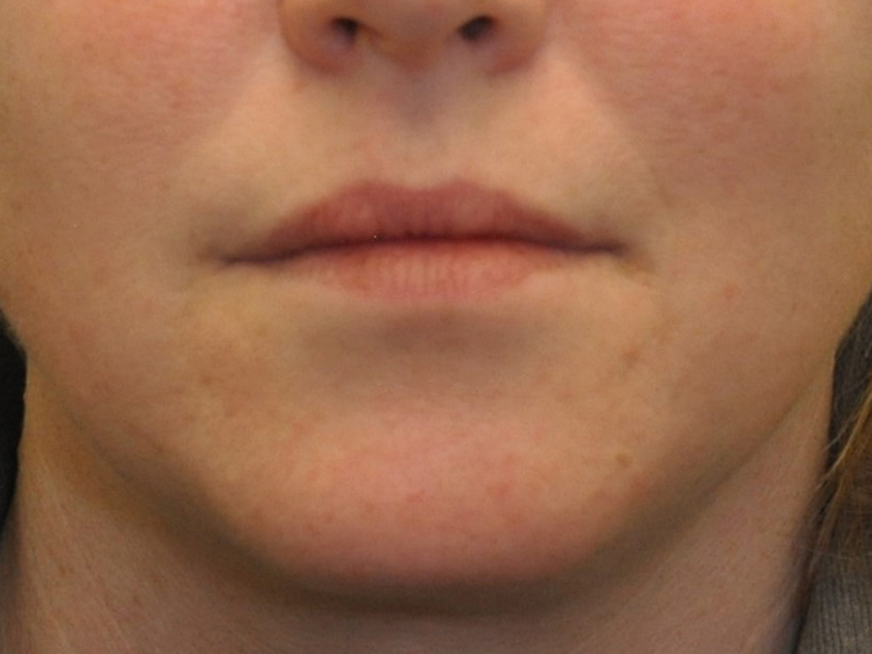 Injectables Before and After | Steven Ringler MD - Center for Aesthetics And Plastic Surgery