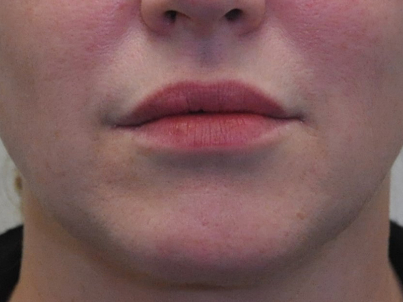 Injectables Before and After | Steven Ringler MD - Center for Aesthetics And Plastic Surgery