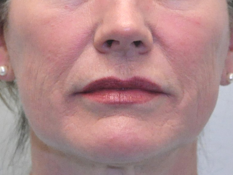 Injectables Before and After | Steven Ringler MD - Center for Aesthetics And Plastic Surgery