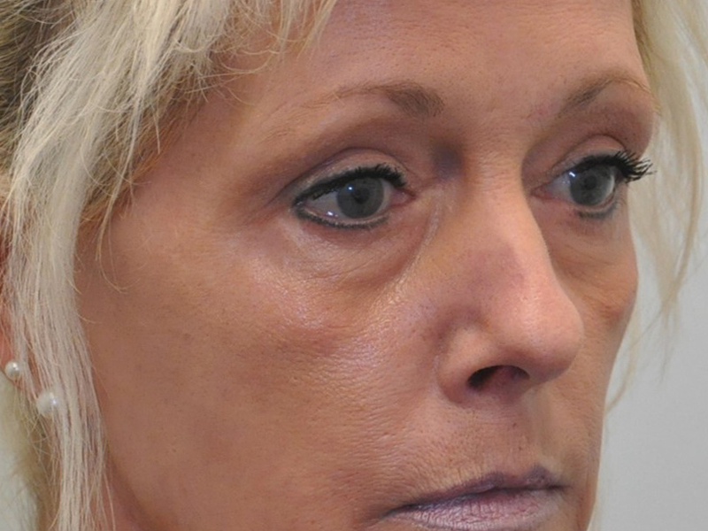 Skinpen Before and After | Steven Ringler MD - Center for Aesthetics And Plastic Surgery