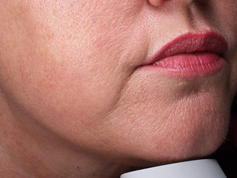 Skinpen Before and After | Steven Ringler MD - Center for Aesthetics And Plastic Surgery