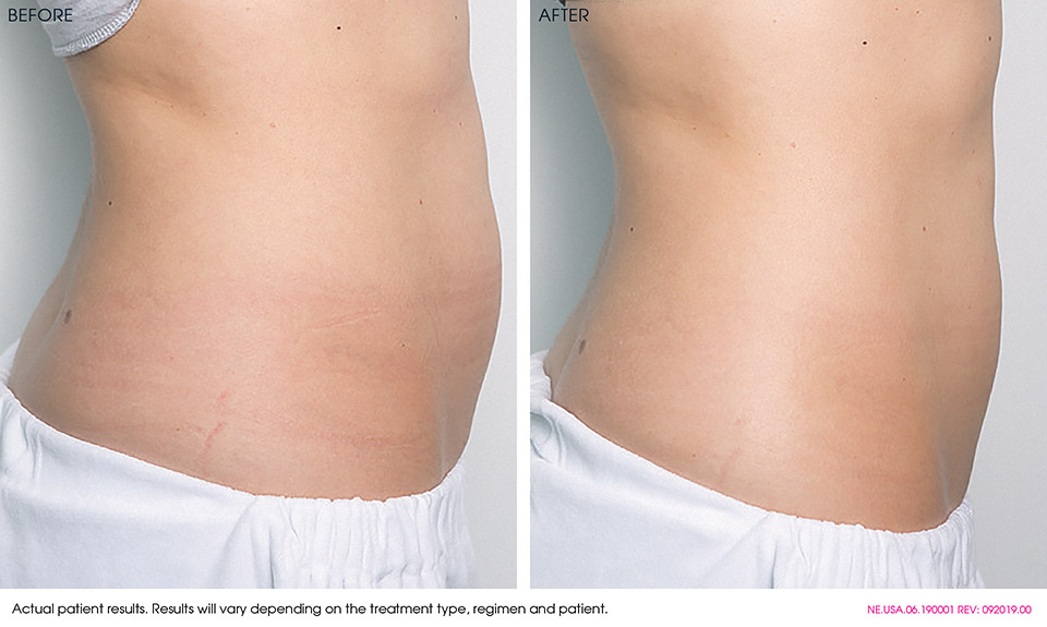 Zaffiro Hydra-Thermo Lift